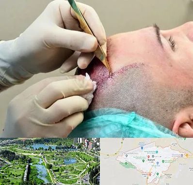 کلینیک کاشت مو در بجنورد