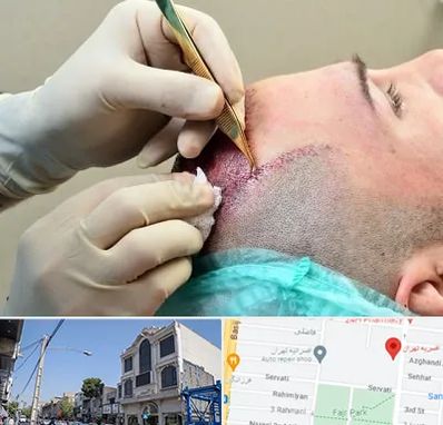 کلینیک کاشت مو در افسریه