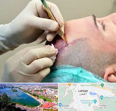 کلینیک کاشت مو در لاهیجان