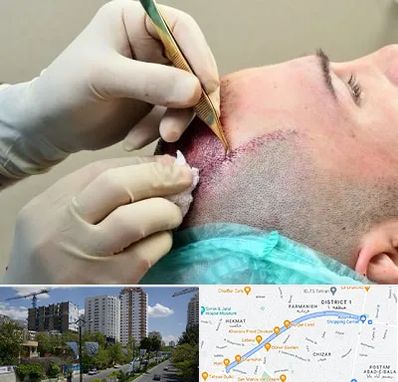 کلینیک کاشت مو در اندرزگو