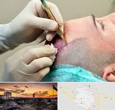 کلینیک کاشت مو در قوچان