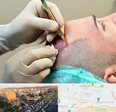 کلینیک کاشت مو در تهرانپارس