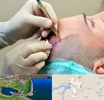 کلینیک کاشت مو در مهاباد