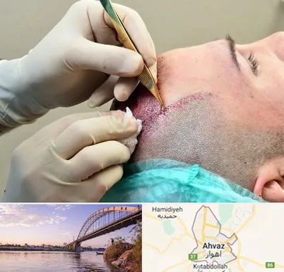 کلینیک کاشت مو در اهواز