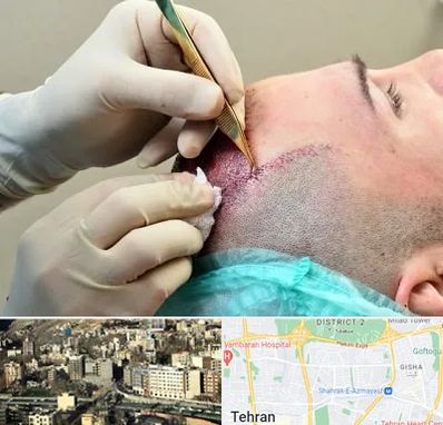 کلینیک کاشت مو در مرزداران