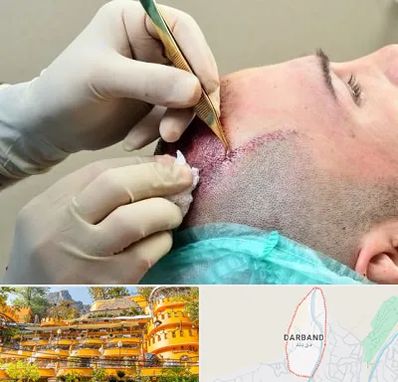 کلینیک کاشت مو در دربند