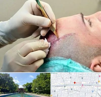 کلینیک کاشت مو در هشت بهشت اصفهان