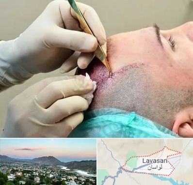 کلینیک کاشت مو در لواسان