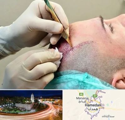 کلینیک کاشت مو در همدان