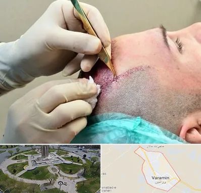 کلینیک کاشت مو در ورامین