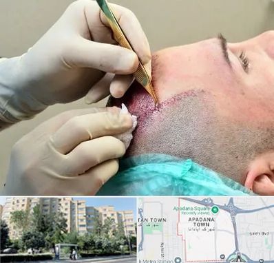 کلینیک کاشت مو در آپادانا