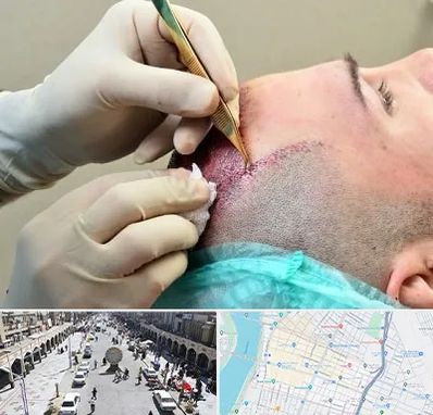 کلینیک کاشت مو در نادری اهواز