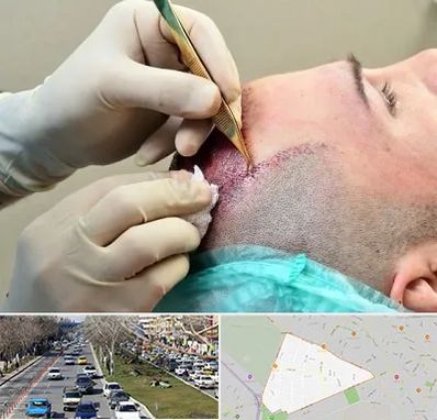 کلینیک کاشت مو در احمدآباد مشهد