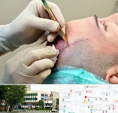 کلینیک کاشت مو در طالقانی