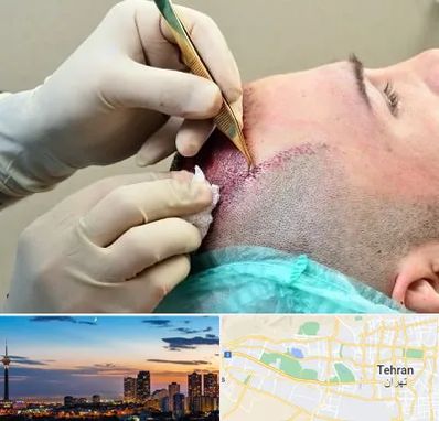 کلینیک کاشت مو در غرب تهران