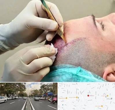 کلینیک کاشت مو در دولت