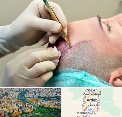 کلینیک کاشت مو در اردبیل