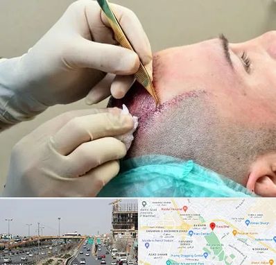 کلینیک کاشت مو در بلوار توس مشهد