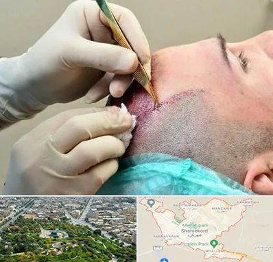 کلینیک کاشت مو در شهرکرد