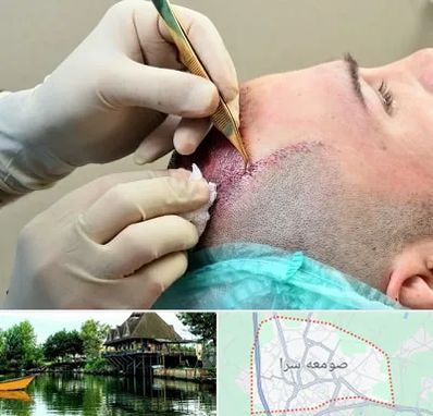 کلینیک کاشت مو در صومعه سرا