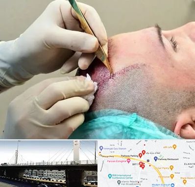 کلینیک کاشت مو در پارک وی