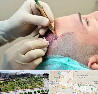 کلینیک کاشت مو در پردیس