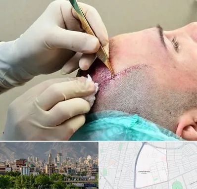 کلینیک کاشت مو در جمشیدیه