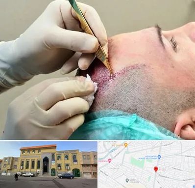 کلینیک کاشت مو در زنبیل آباد قم