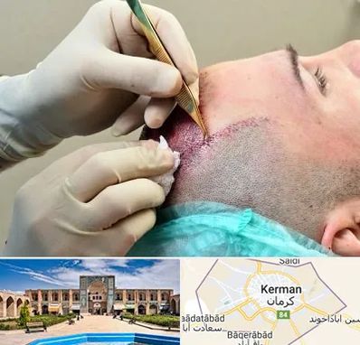 کلینیک کاشت مو در کرمان
