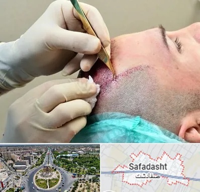 کلینیک کاشت مو در صفادشت