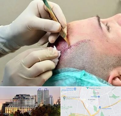 کلینیک کاشت مو در فرشته