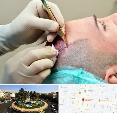 کلینیک کاشت مو در هفت حوض