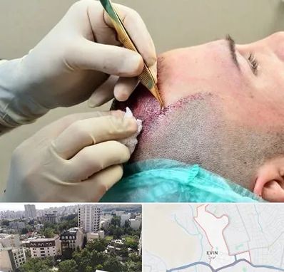 کلینیک کاشت مو در اوین