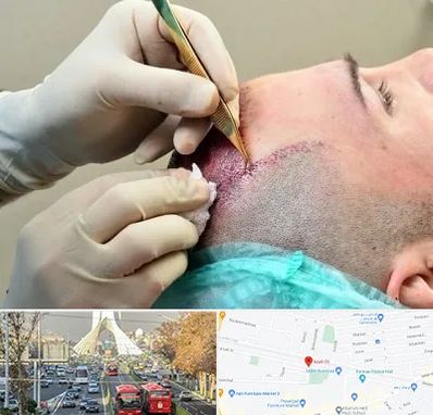 کلینیک کاشت مو در خیابان آزادی