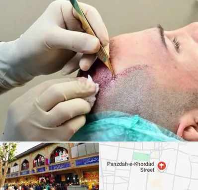 کلینیک کاشت مو در 15 خرداد