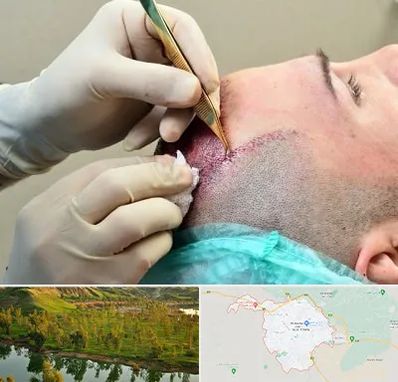 کلینیک کاشت مو در بهبهان