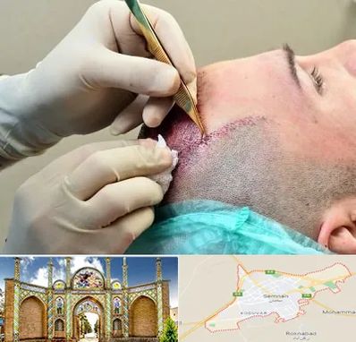 کلینیک کاشت مو در سمنان