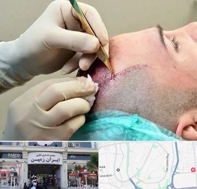 کلینیک کاشت مو در ایران زمین