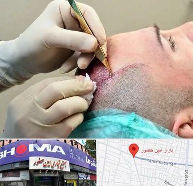 کلینیک کاشت مو در امین حضور