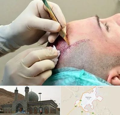 کلینیک کاشت مو در شهرضا