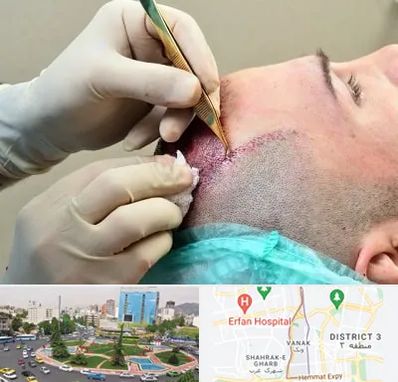 کلینیک کاشت مو در ونک