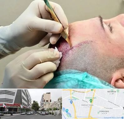 کلینیک کاشت مو در بلوار فردوس