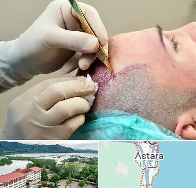 کلینیک کاشت مو در آستارا