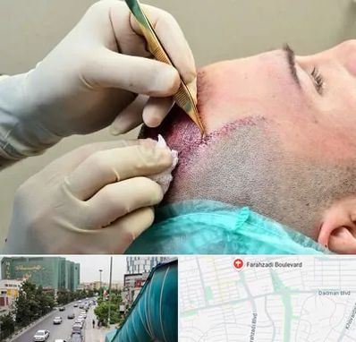 کلینیک کاشت مو در بلوار فرحزادی