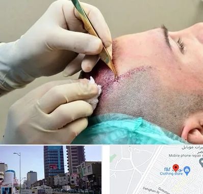 کلینیک کاشت مو در چهارراه طالقانی کرج