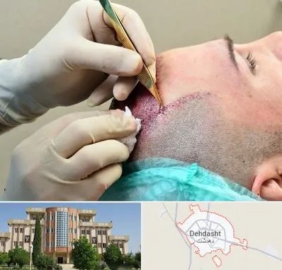 کلینیک کاشت مو در دهدشت