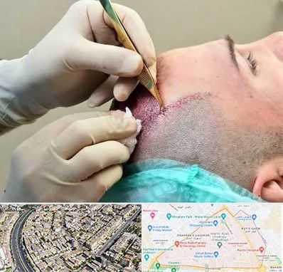 کلینیک کاشت مو در شهرک غرب مشهد