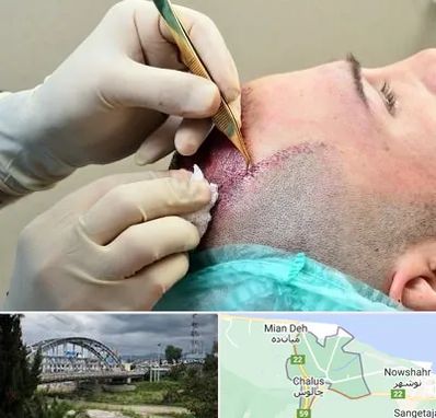 کلینیک کاشت مو در چالوس