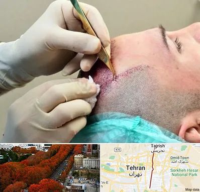 کلینیک کاشت مو در ولیعصر