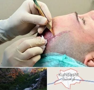 کلینیک کاشت مو در کوهدشت